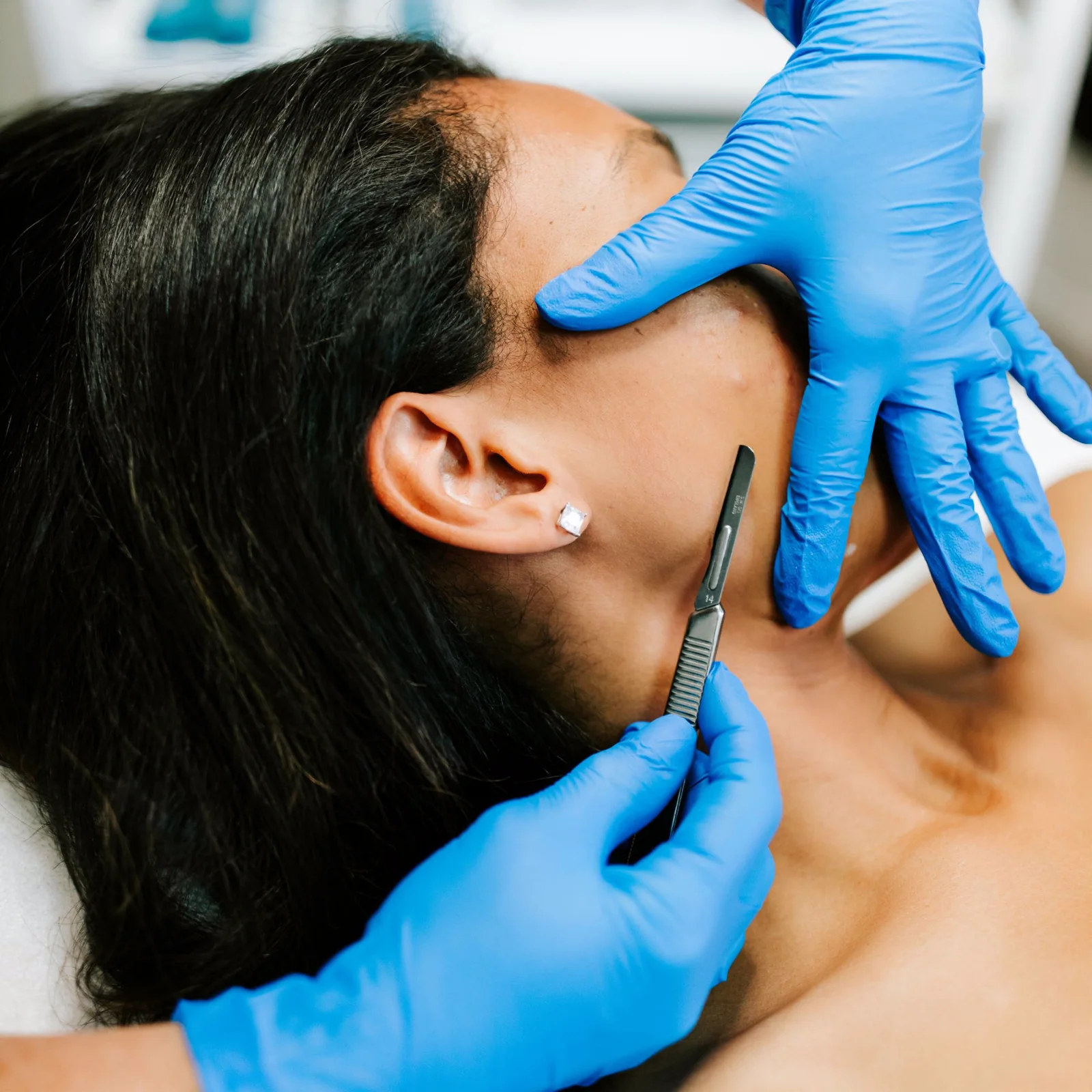 Dermaplaning