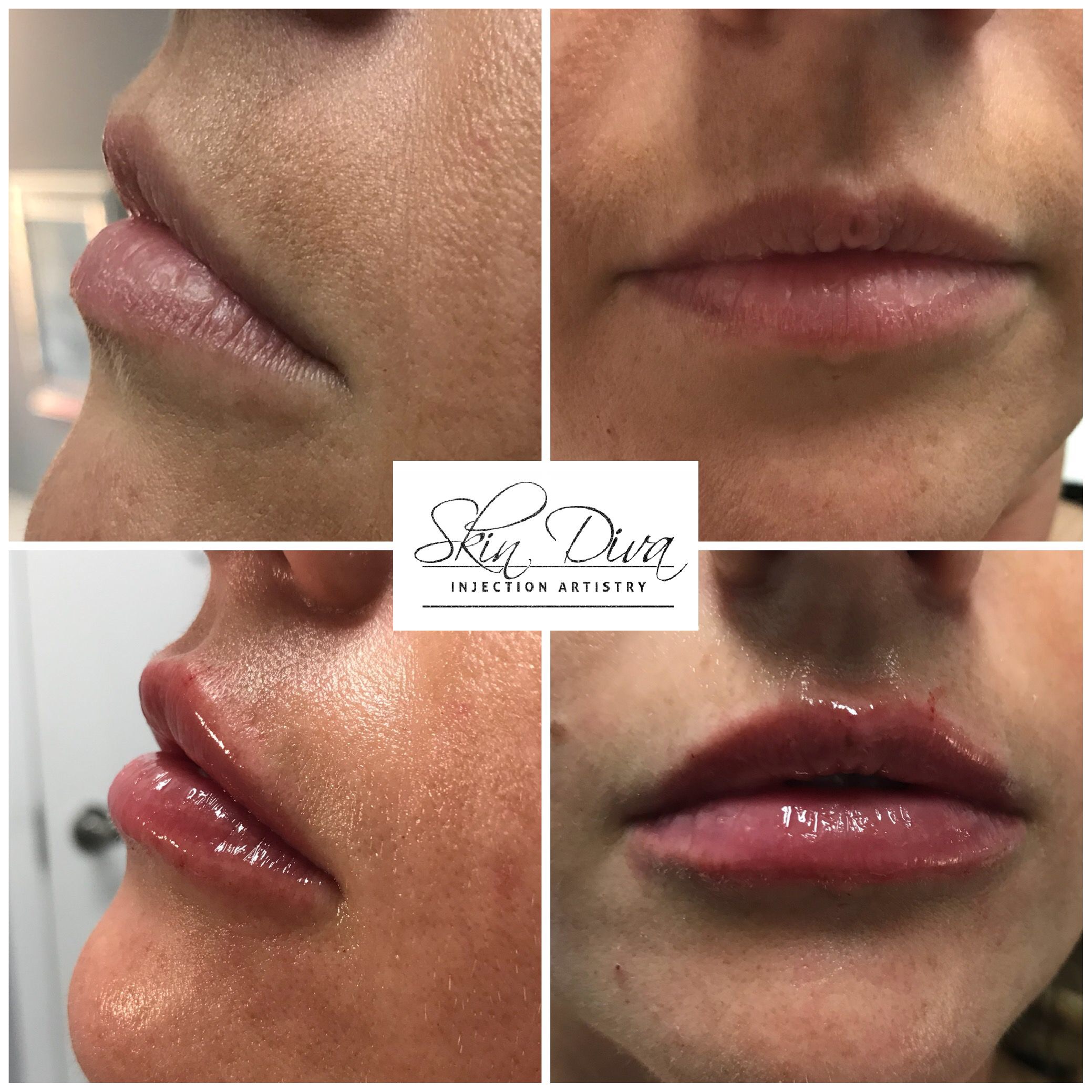 Skin Diva lip enhancement before and after