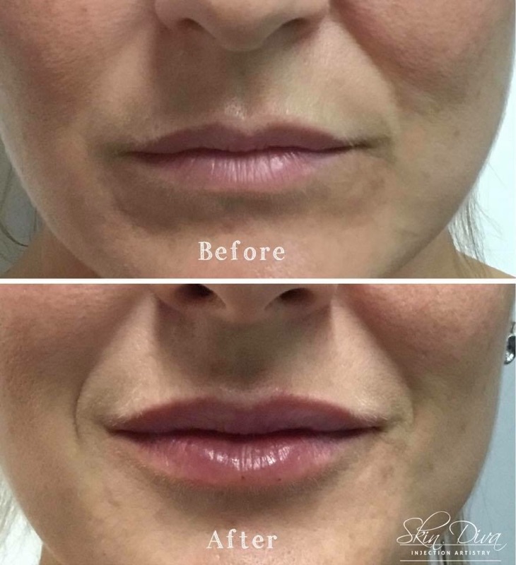 Skin Diva lip filler before and after