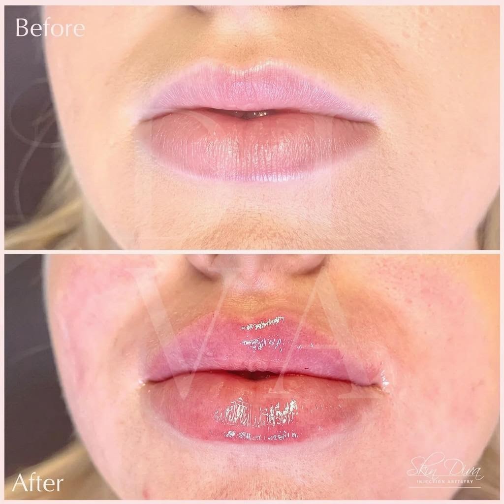 Lip Filler