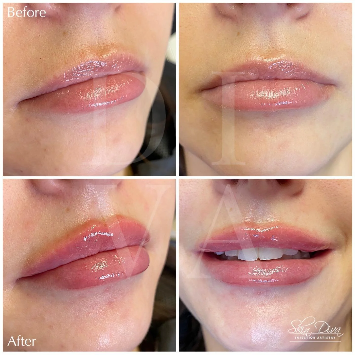 Why We Love Lip Filler