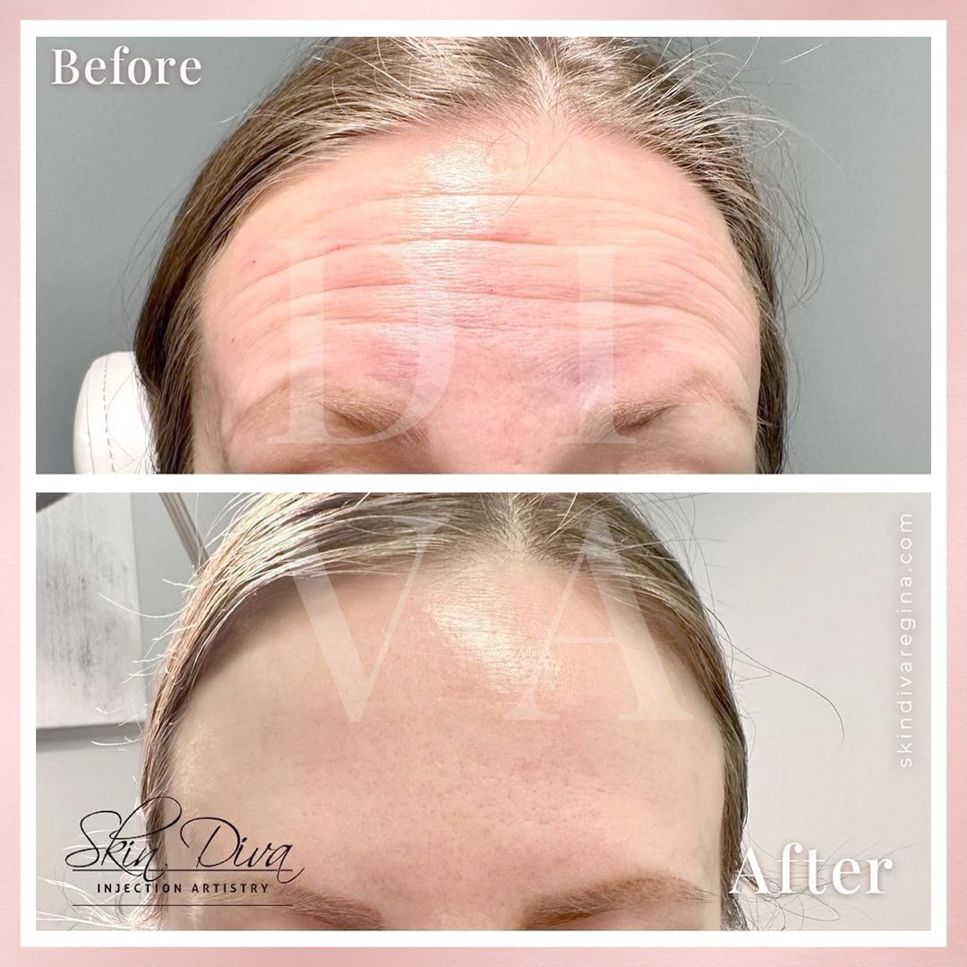 Neuromodulator before and after result 5 at Skin Diva Regina