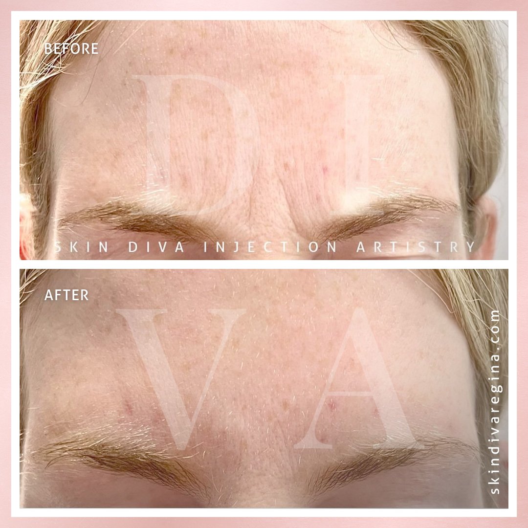 Neuromodulator before and after result 6 at Skin Diva Regina