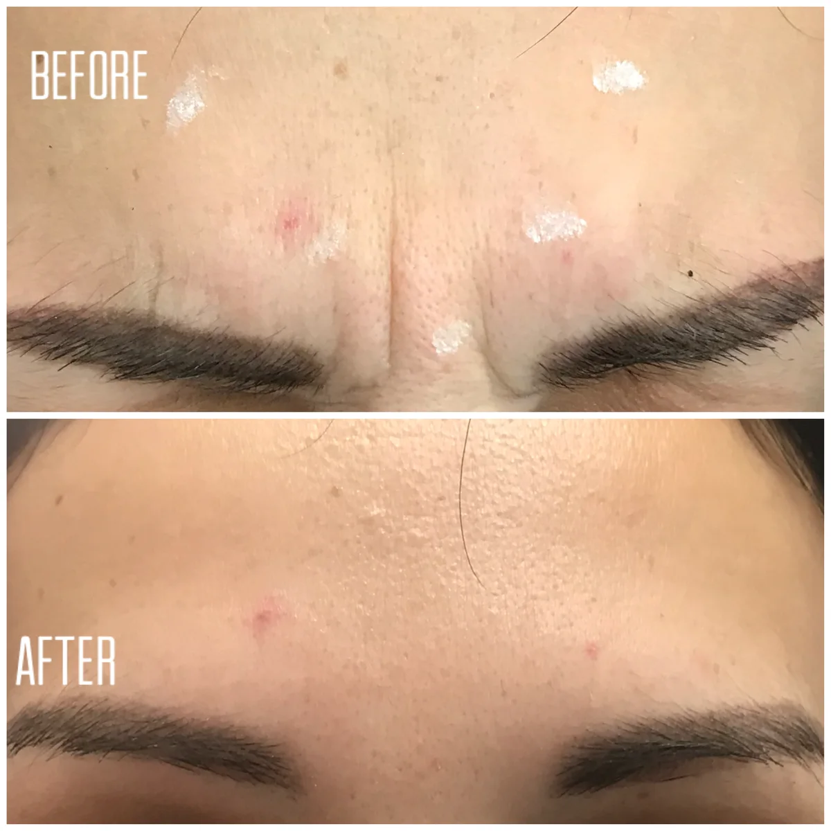 Neuromodulator before and after result 7 at Skin Diva Regina