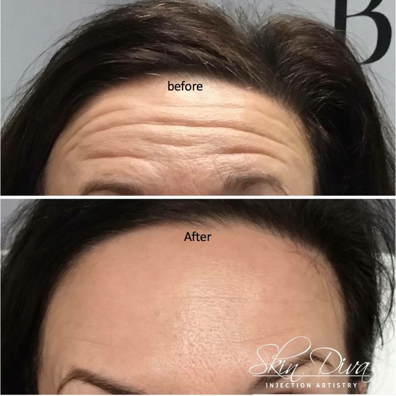 Neuromodulator before and after result 11 at Skin Diva Regina