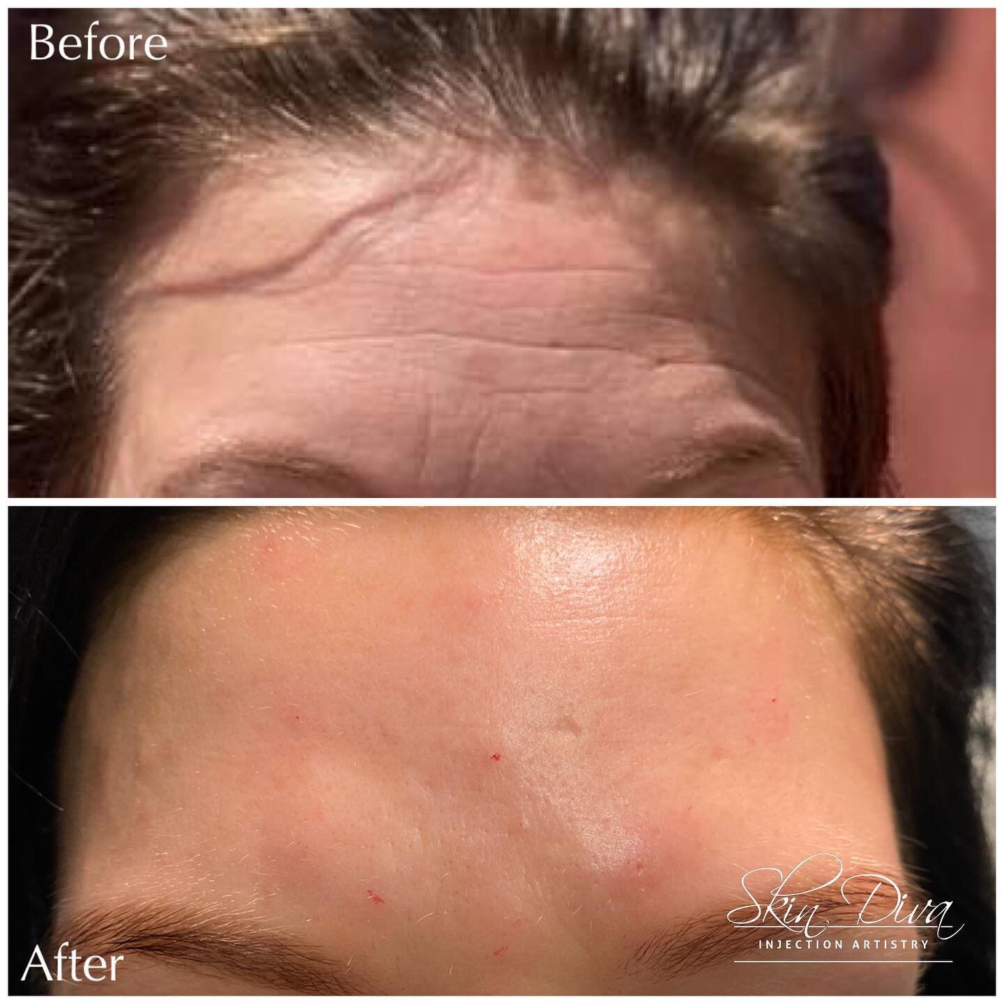Before and after forehead line treatment
