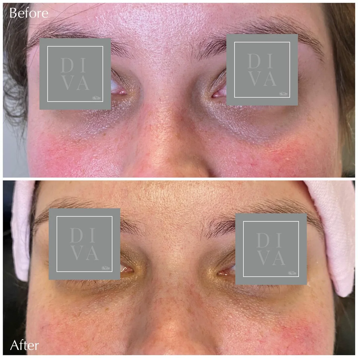 Before and after treatment of the under-eye area, front view
