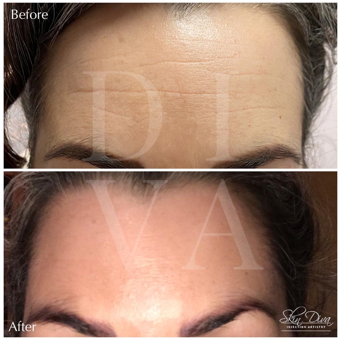 Before and after lip filler treatment on mature lips