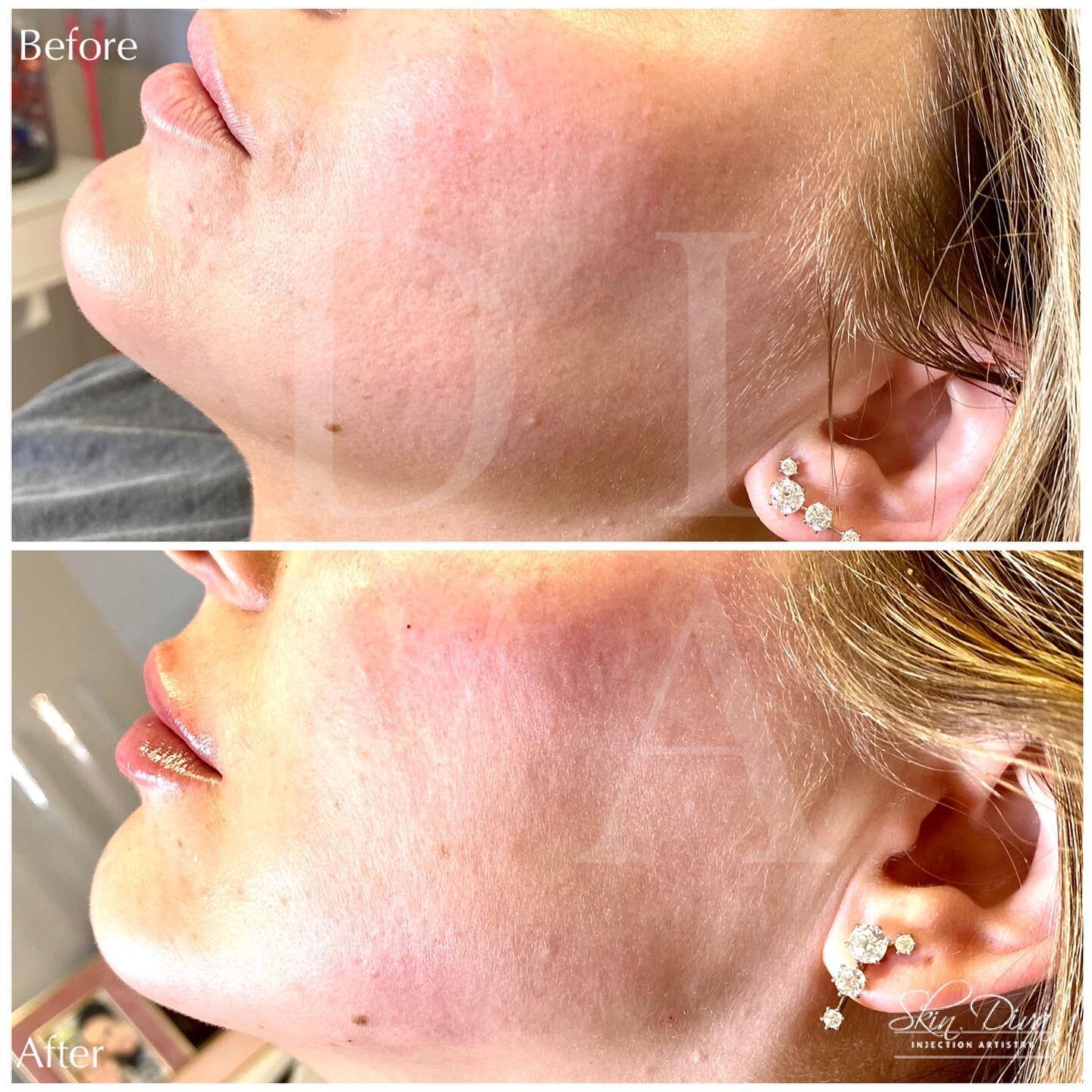 Before and after chin and jawline contouring, profile view