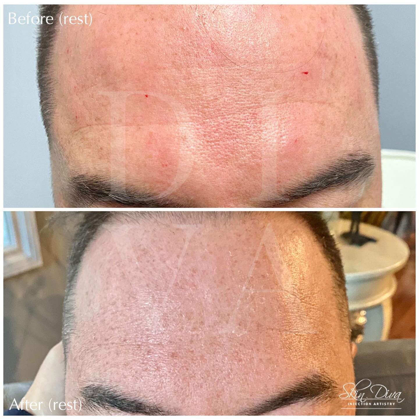 Before and after forehead line smoothing treatment