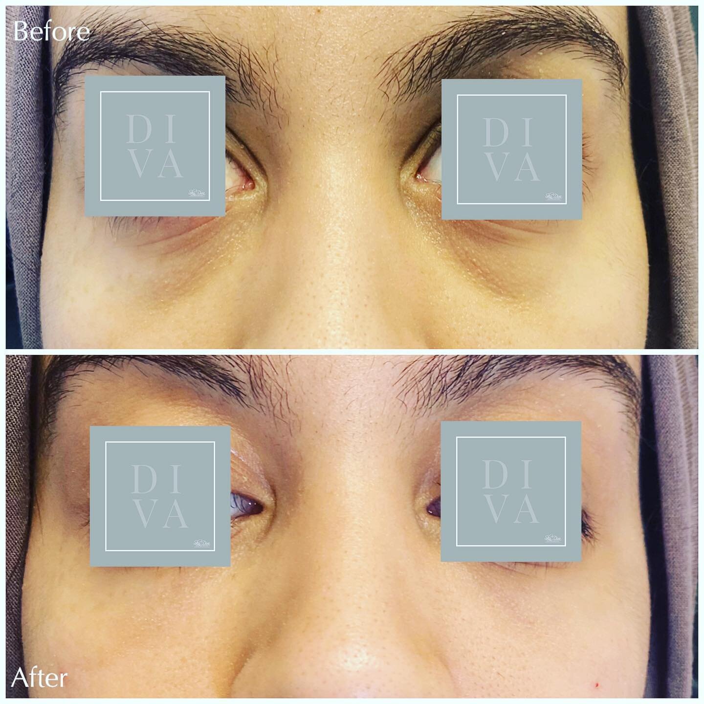 Before and after under-eye rejuvenation, close-up view
