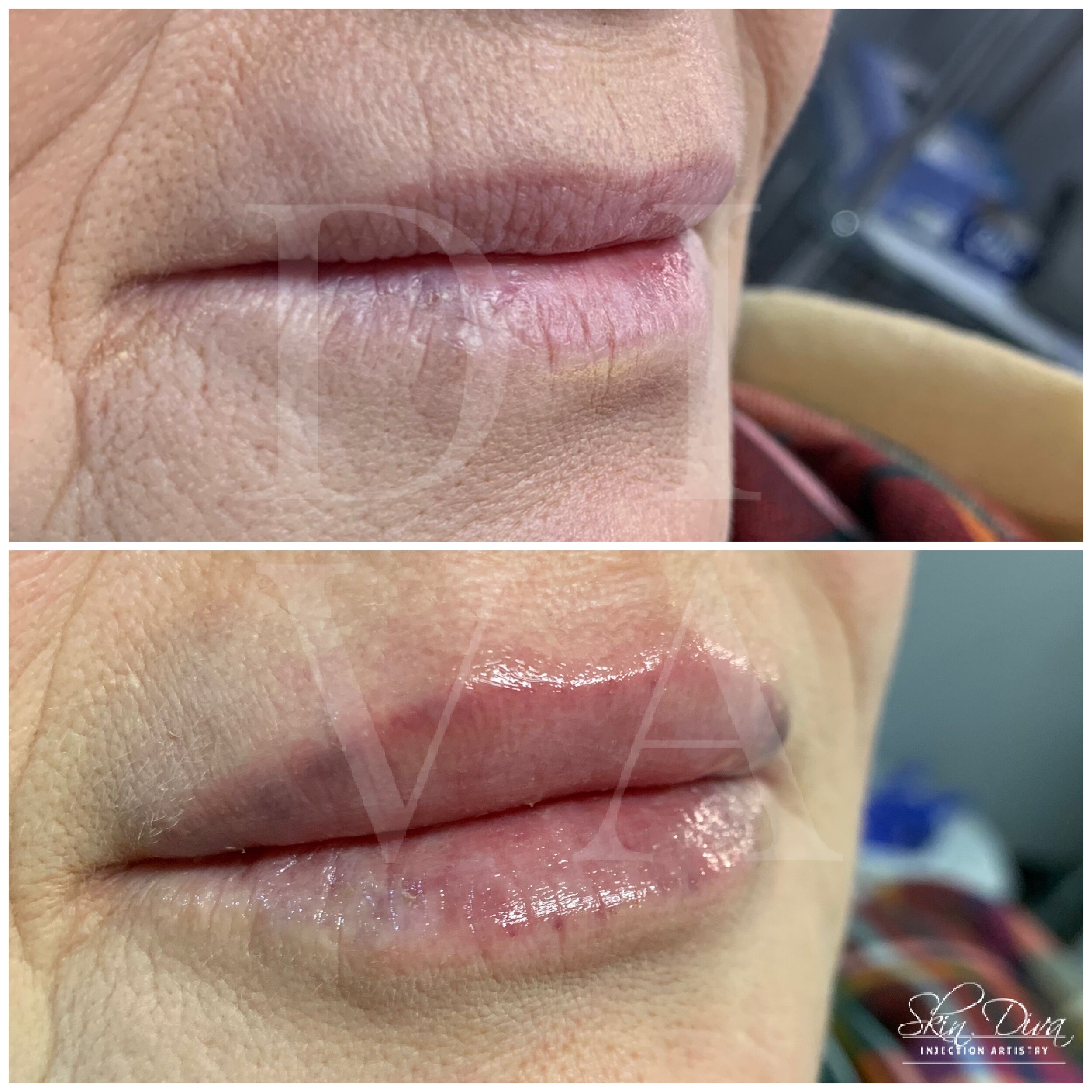 Before and after subtle lip filler treatment