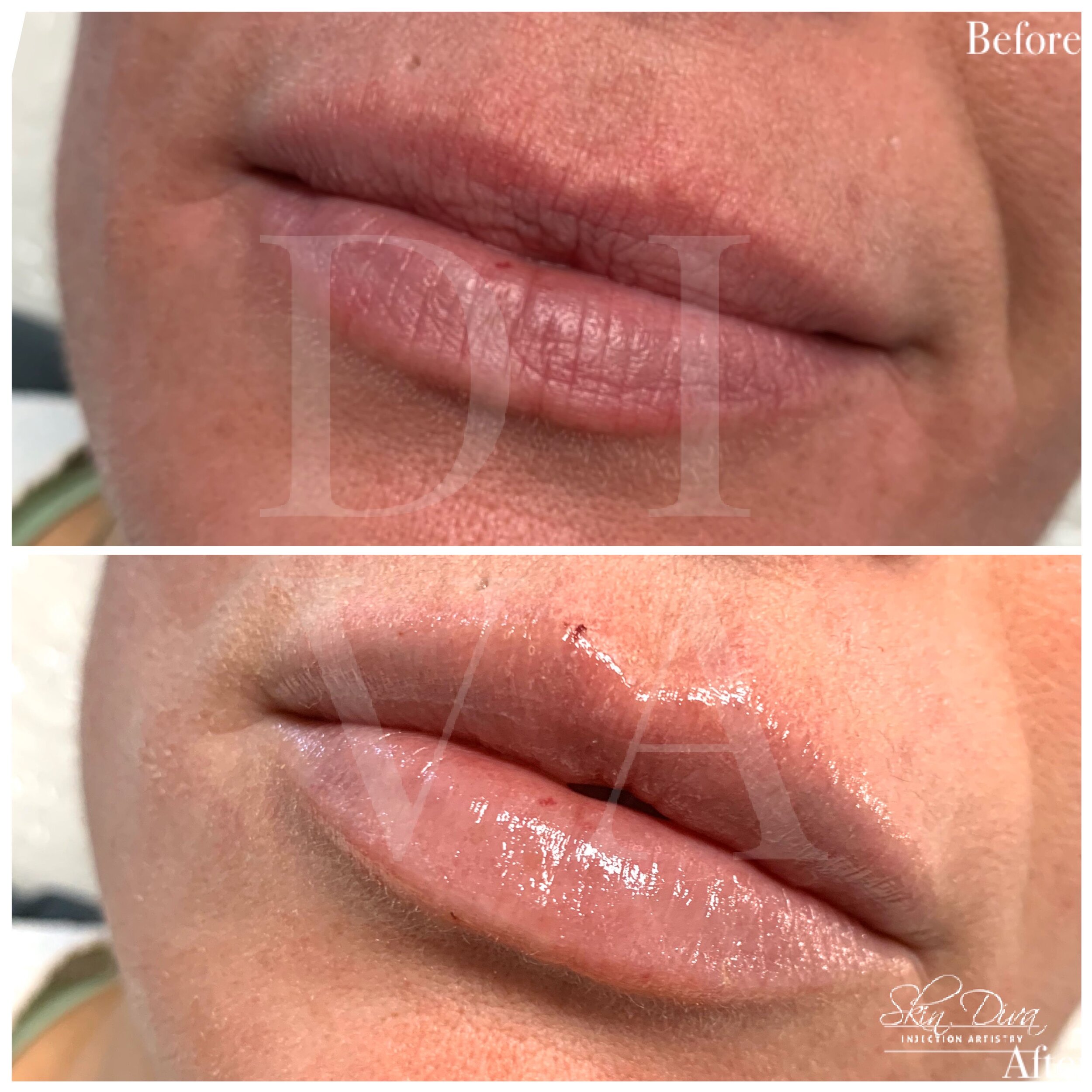 Before and after lip filler treatment with added definition